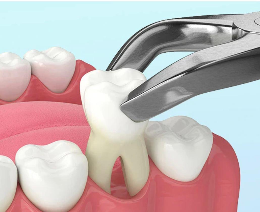 Teeth Cleaning