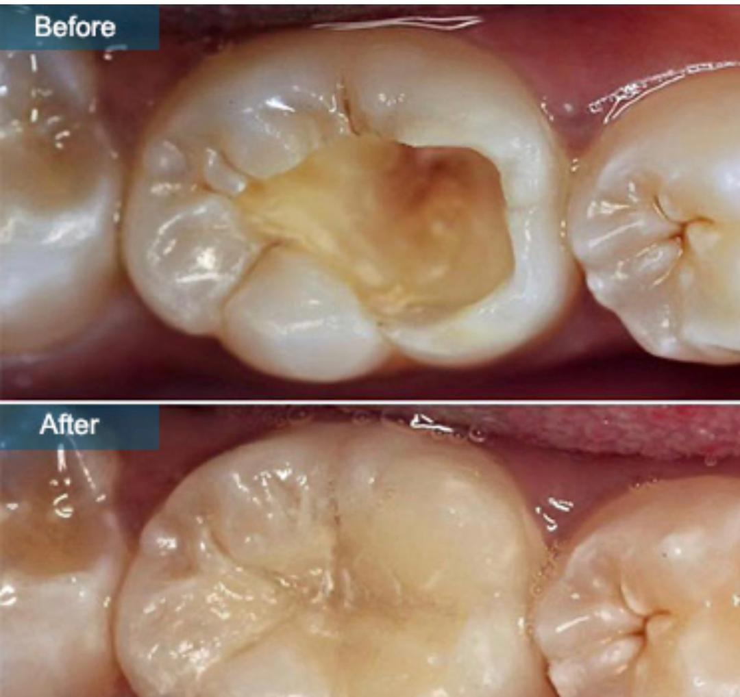 Root Canal