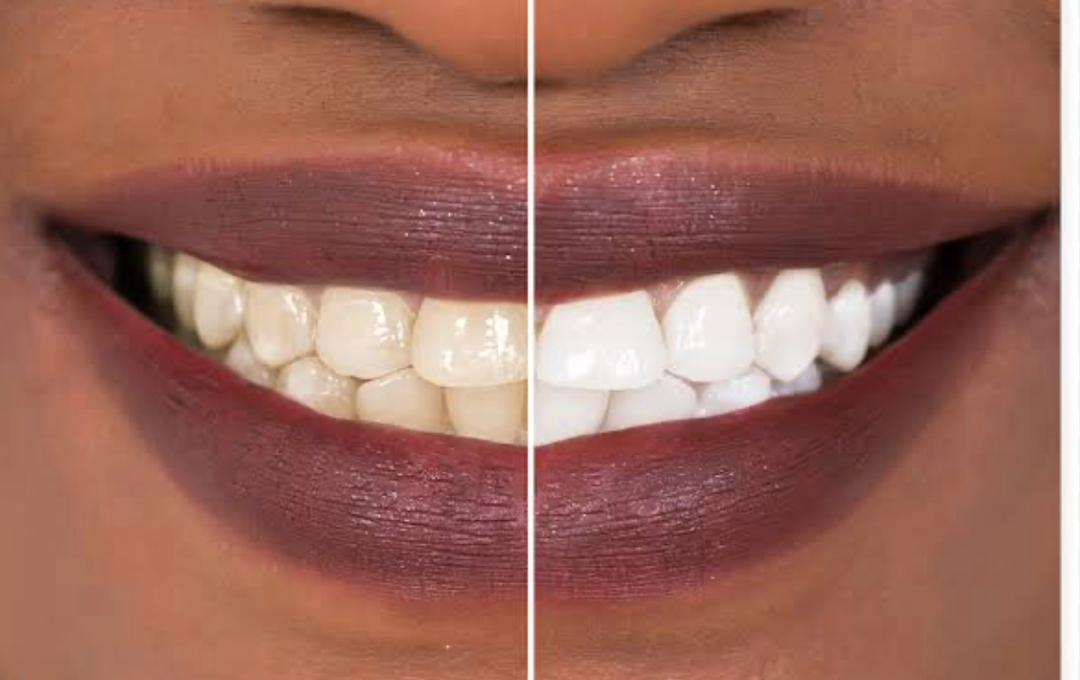 Teeth Whitening